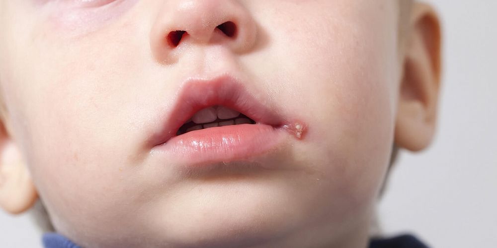 Герпес на губах у ребенка — описание инфекции (вируса), причины появления, симптомы